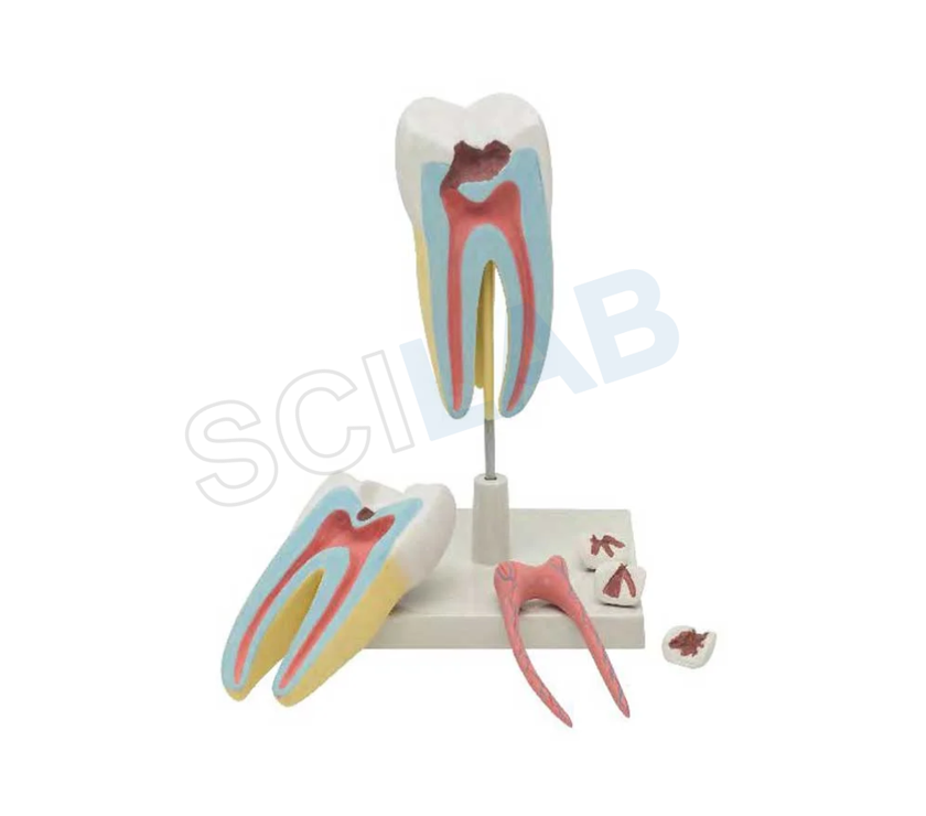 Advanced Human Tooth Model: Upper Triple Root Molar with Caries