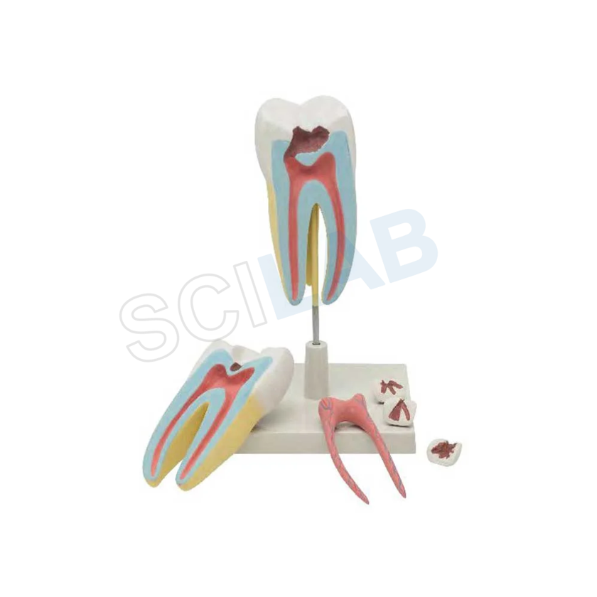 Advanced Human Tooth Model: Upper Triple Root Molar with Caries