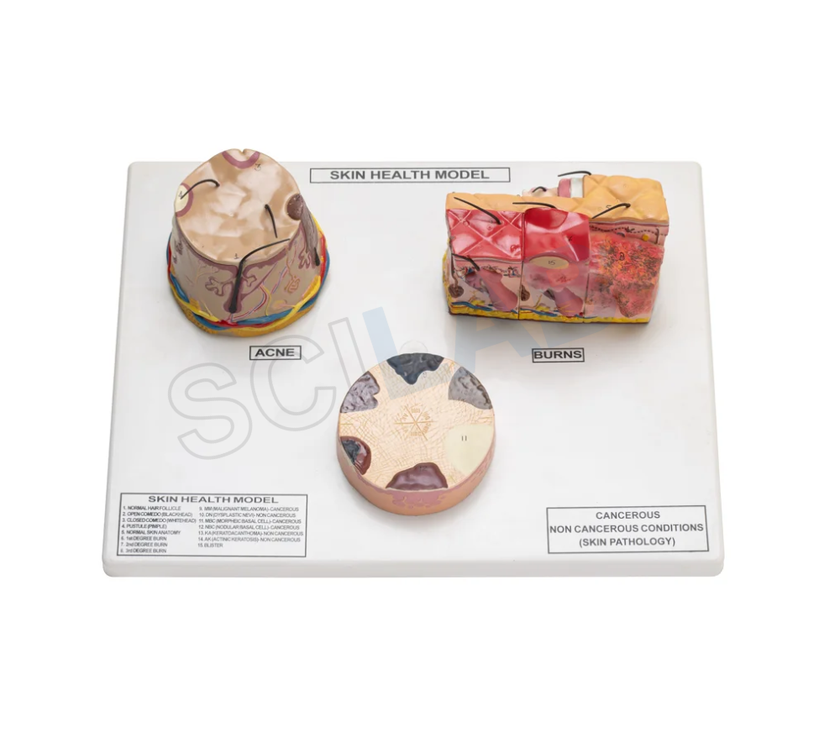 Skin Cancer, Acne Burn Model