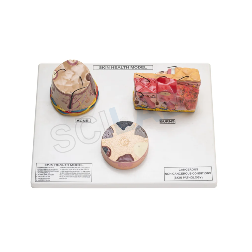 Skin Cancer, Acne Burn Model