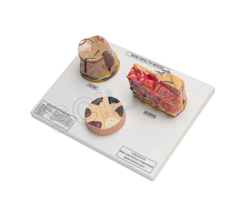 Skin Cancer, Acne Burn Model