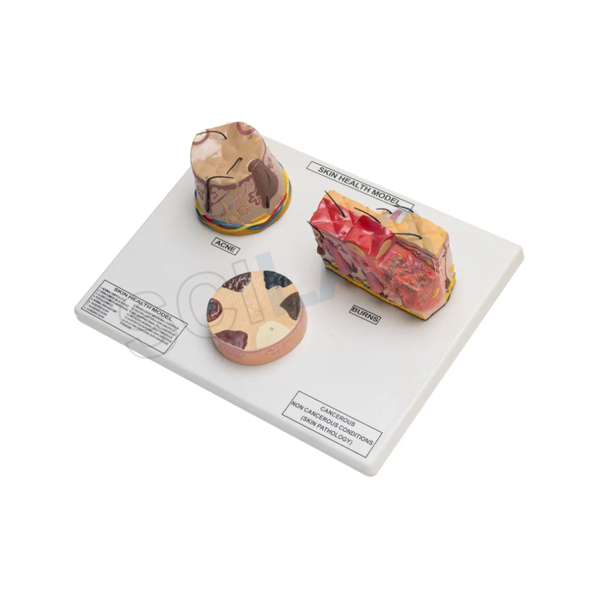 Skin Cancer, Acne Burn Model